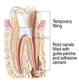 Root Canal in Winchester, VA