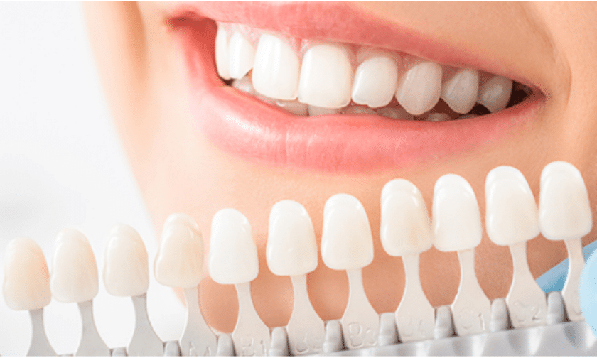 Teeth Whitening In Winchester, VA