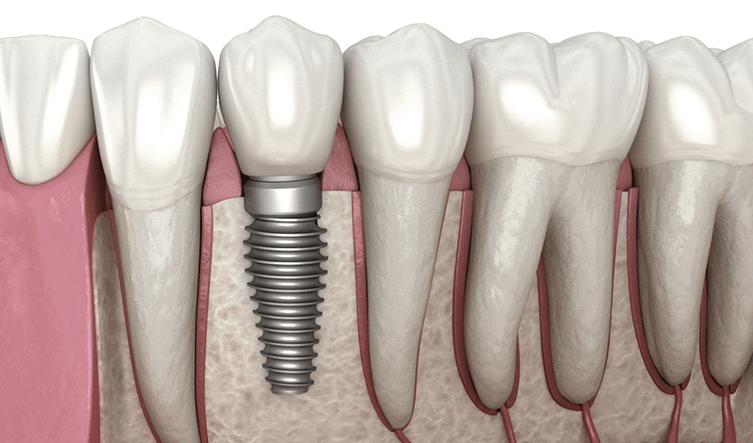 dental implant in Winchester, VA