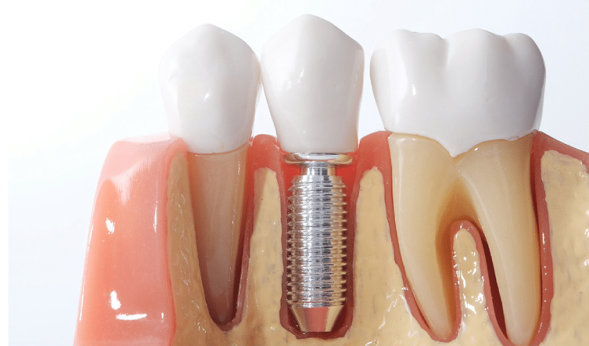 Dental Implants Winchester, VA