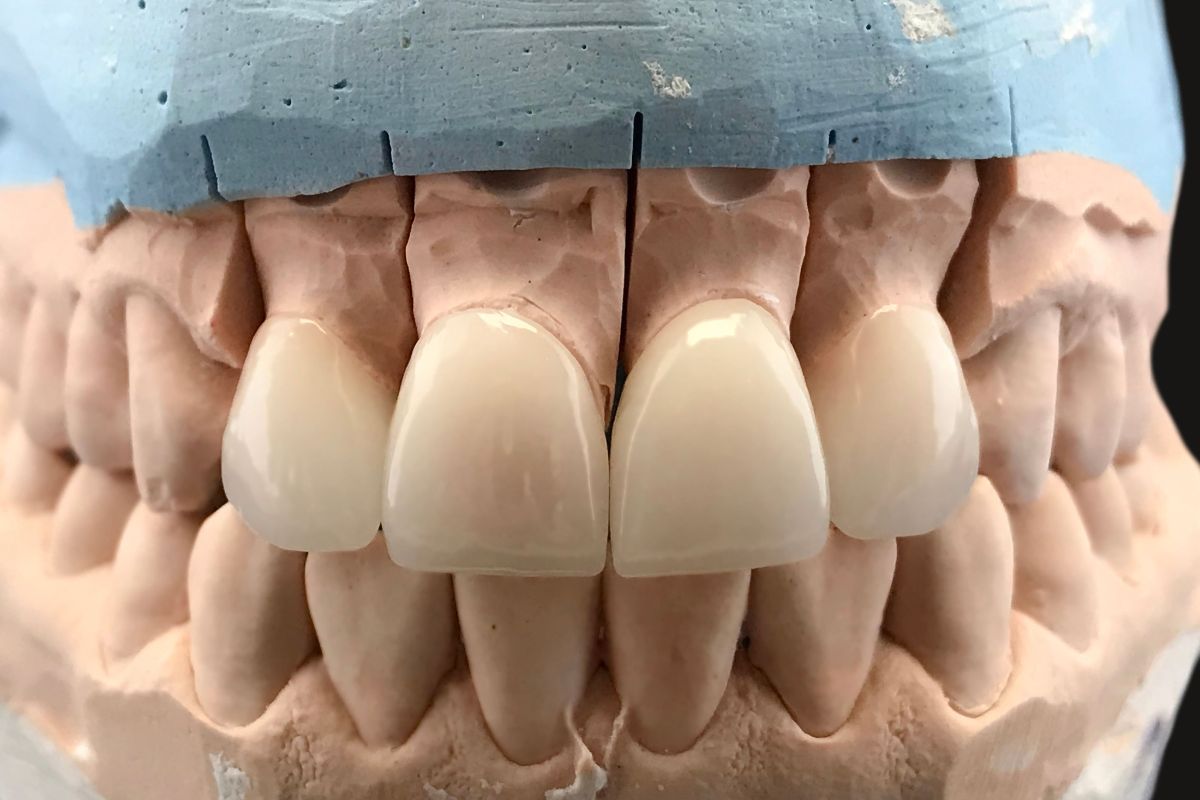 Dental model displaying four front teeth crowns on gum replica for treatment planning.