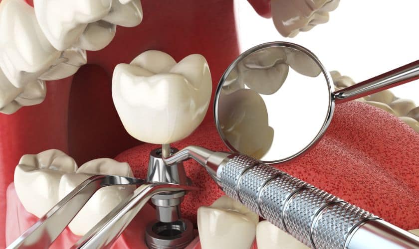 Dental Implants in Winchester - Shenandoah Family Dentistry - Winchester
