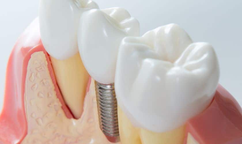 Dental Implants in Winchester - Shenandoah Family Dentistry - Winchester