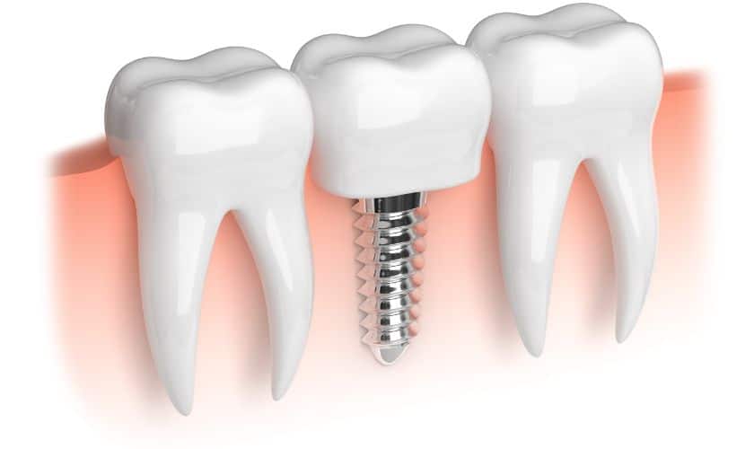 Dental Implants Winchester - Shenandoah Family Dentistry - Winchester