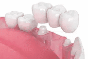 Dental crowns displayed on pink model showing tooth restoration options for family dentistry.
