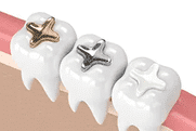 Three white tooth models with metal brackets on pink orthodontic wire against tan background.