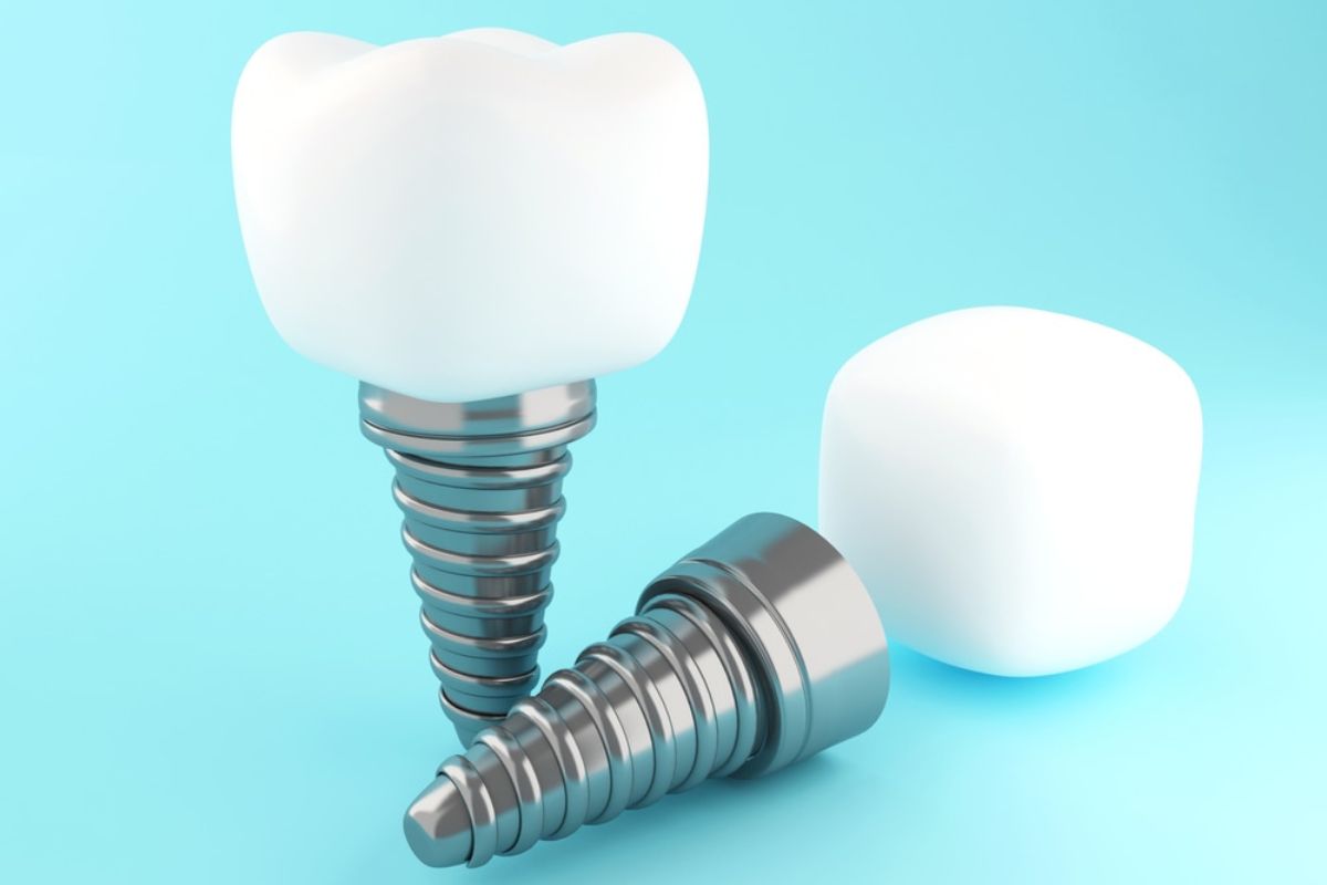 Single-Tooth Dental Implants In Winchester