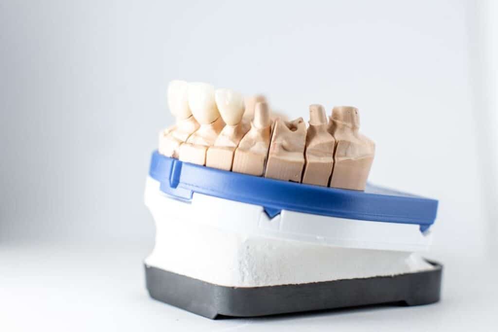Dental crown shade guide model showing tooth color options for crown replacement.
