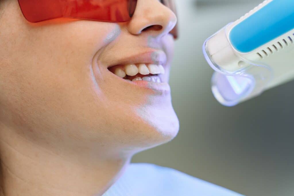 Patient receiving professional teeth whitening treatment with blue gel applicator in Winchester.