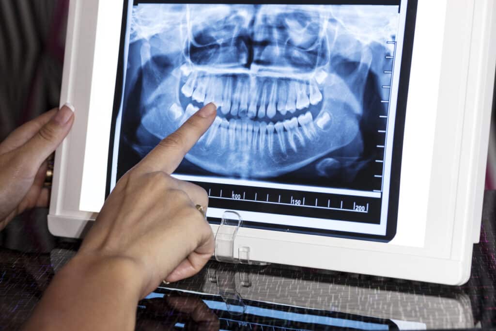Dentist examining panoramic X-ray of patient's teeth and jaw structure.