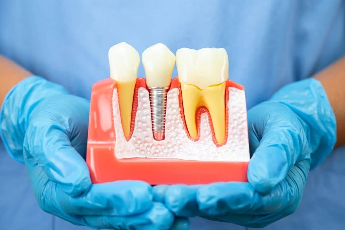 Dental Implants Winchester