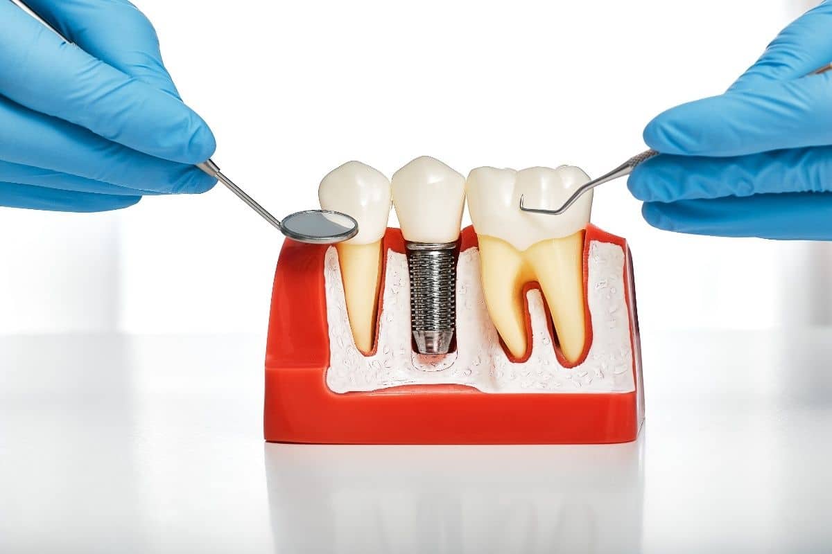 Dental Implants Winchester