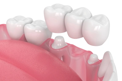 Dental crowns and onlays used to restore damaged teeth