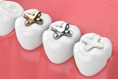 Dental fillings restoring damaged teeth