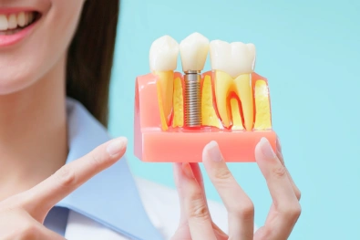 Dental implants used to replace missing teeth