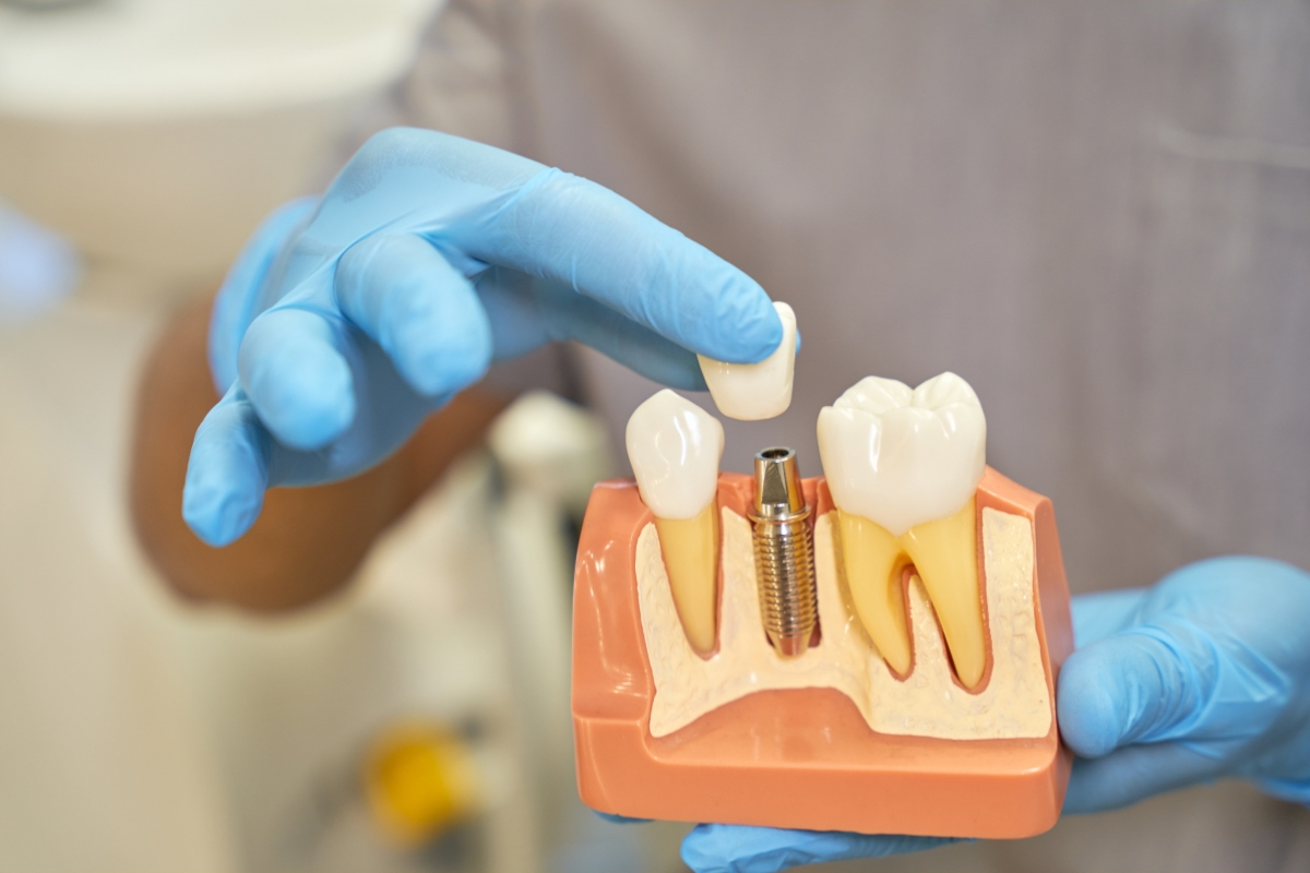 Can I Eat Hard Foods After Dental Implants?